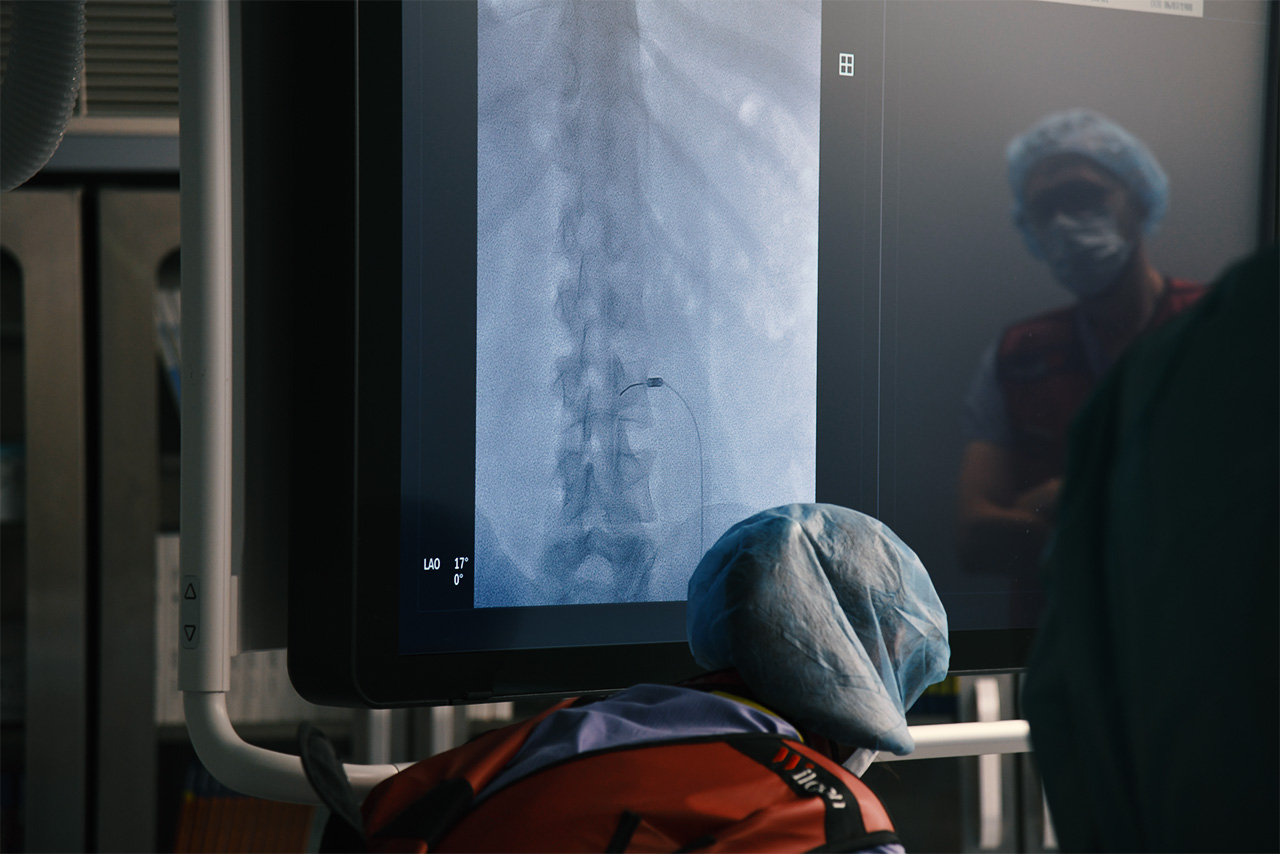 Lekarze z oddziału neurochirurgicznego Wojewódzkiego Szpitala Specjalistycznego w Słupsku zaczynają przeprowadzać zabiegi termolezji, czyli leczenia bólu za pomocą wysokiej temperatury.