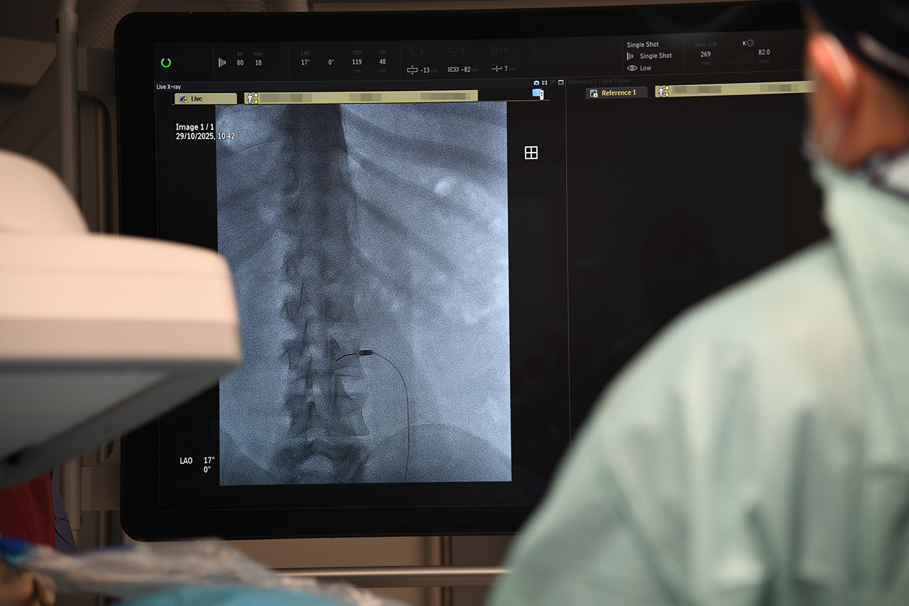 Lekarze z oddziału neurochirurgicznego Wojewódzkiego Szpitala Specjalistycznego w Słupsku zaczynają przeprowadzać zabiegi termolezji, czyli leczenia bólu za pomocą wysokiej temperatury.